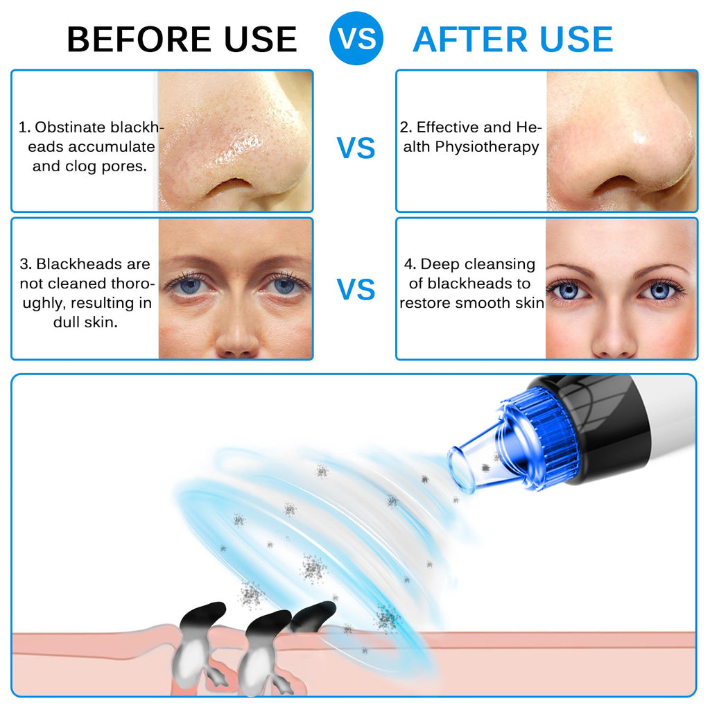 Blackhead Remover Vacuum Pore Cleaner