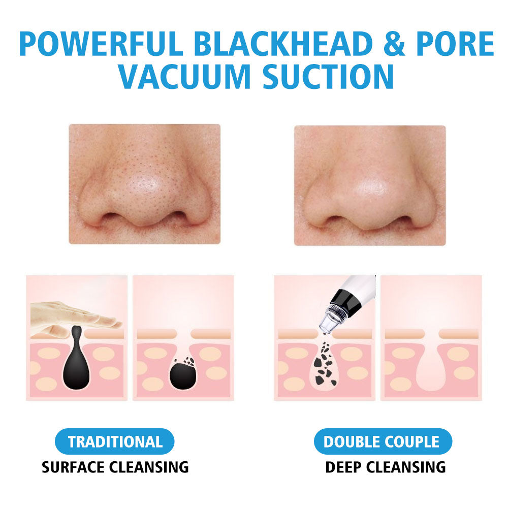 Blackhead Remover Vacuum Pore Cleaner